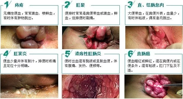 便血的原因有哪些？老人、小孩、腹泻出血要紧吗？