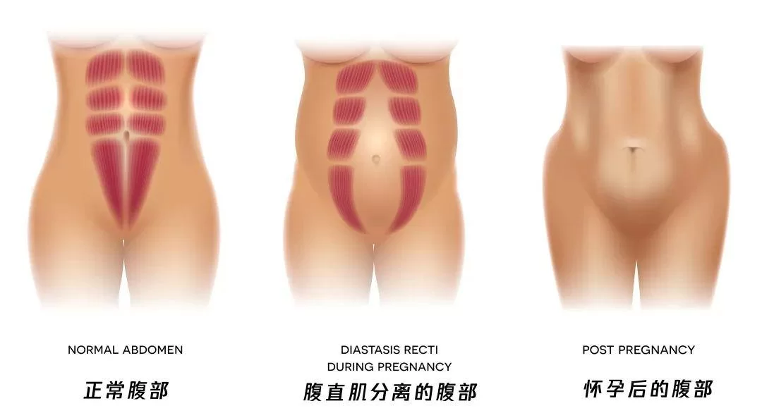 产后康复具体都有哪些项目,做一次大概要花多少钱?