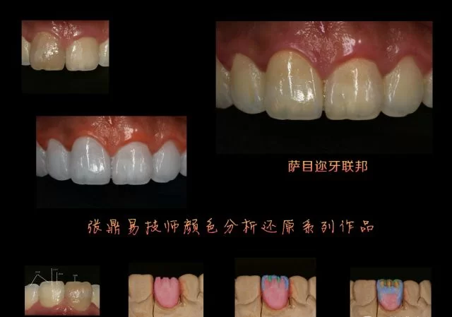 义齿生产搞副业,工艺成本咋兼顾,技师要求有啥讲究?