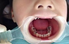 刷完牙还能吃QQ糖吗？牙齿健康与甜食的微妙关系