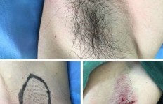 狐臭微创手术后会留下疤痕吗？一组真实术后图片告诉你答案！