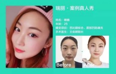芜湖瑞丽整形效果如何？求真实评价与体验分享！