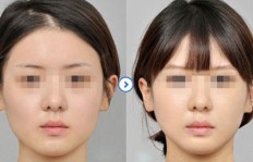 瘦脸针注射能否成为高收益项目？真相究竟如何？