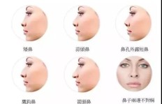 鼻子整形手术后，效果真的能永久保持不变吗？